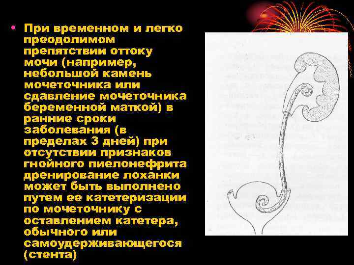  • При временном и легко преодолимом препятствии оттоку мочи (например, небольшой камень мочеточника