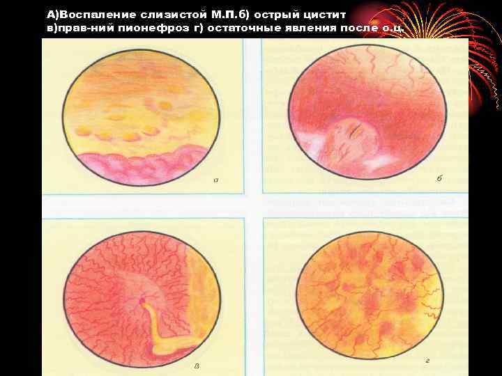 А)Воспаление слизистой М. П. б) острый цистит в)прав ний пионефроз г) остаточные явления после