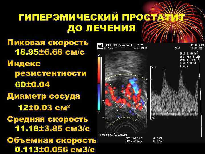 ГИПЕРЭМИЧЕСКИЙ ПРОСТАТИТ ДО ЛЕЧЕНИЯ Пиковая скорость 18. 95± 6. 68 см/с Индекс резистентности 60±