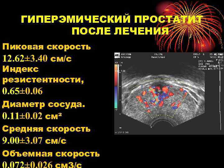 ГИПЕРЭМИЧЕСКИЙ ПРОСТАТИТ ПОСЛЕ ЛЕЧЕНИЯ Пиковая скорость 12. 62± 3. 40 см/с Индекс резистентности, 0.
