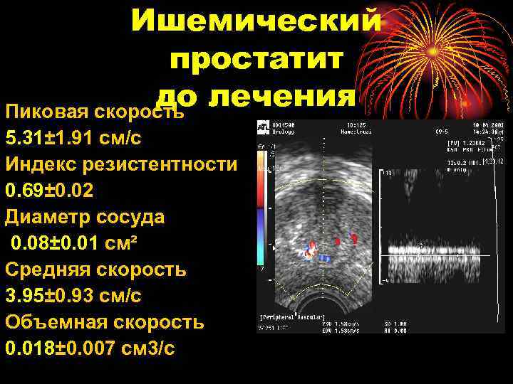 Ишемический простатит до лечения Пиковая скорость 5. 31± 1. 91 см/с Индекс резистентности 0.