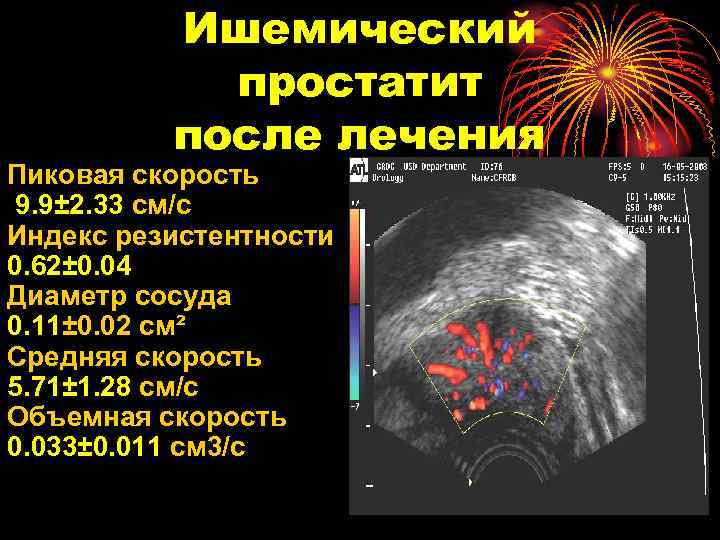 Ишемический простатит после лечения Пиковая скорость 9. 9± 2. 33 см/с Индекс резистентности 0.