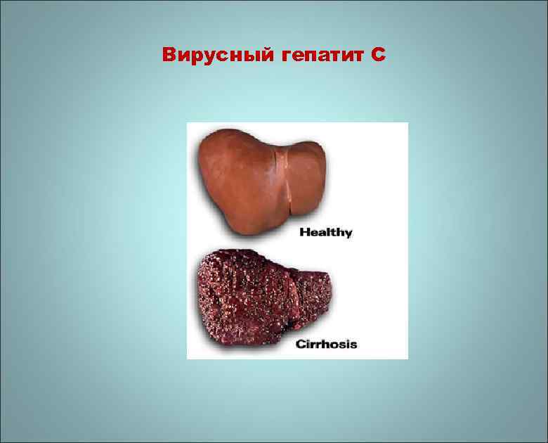 Вирусный гепатит С 