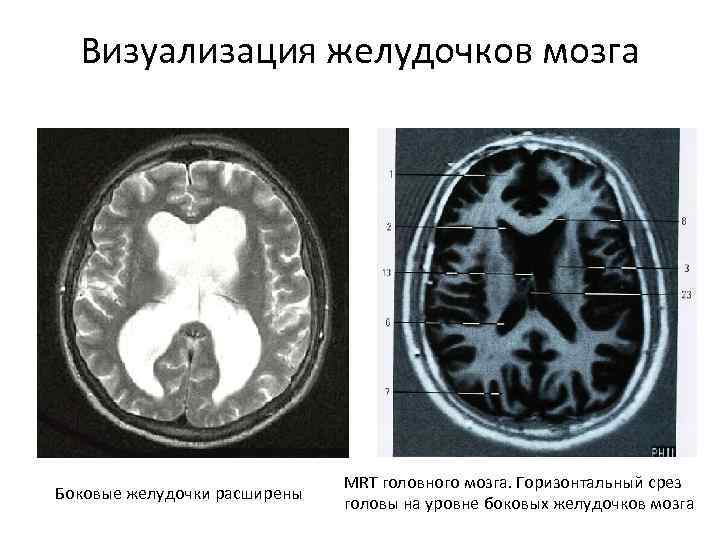 Визуализация желудочков мозга Боковые желудочки расширены MRT головного мозга. Горизонтальный срез головы на уровне
