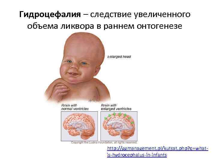 Гидроцефалия – следствие увеличенного объема ликвора в раннем онтогенезе http: //ggmanagement. pl/kutsat. php? q=whatis-hydrocephalus-in-infants