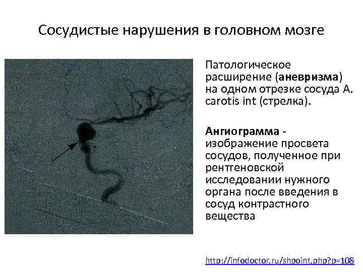 Сосудистые нарушения в головном мозге Патологическое расширение (аневризма) на одном отрезке сосуда A. carotis