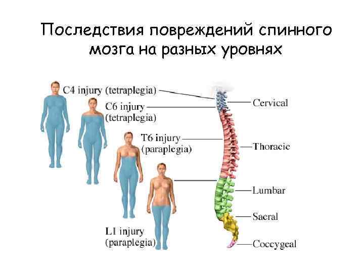 Последствия повреждений спинного мозга на разных уровнях 