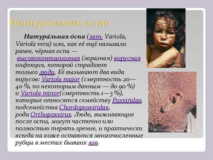 Натуральная оспа Натура льная о спа (лат. Variola, Variola vera) или, как её ещё