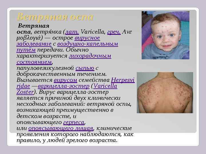 Ветряная оспа, ветря нка (лат. Varicella, греч. Ανε μοβλογιά) — острое вирусное заболевание с