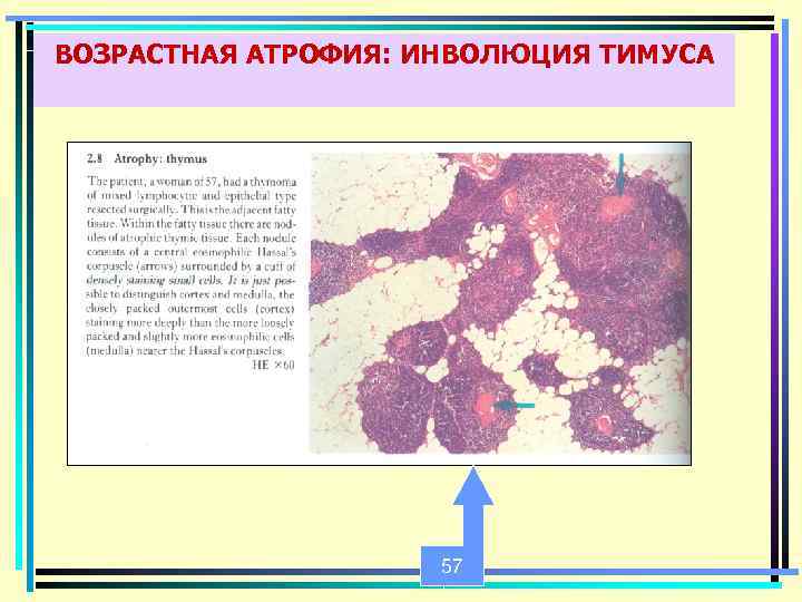 ВОЗРАСТНАЯ АТРОФИЯ: ИНВОЛЮЦИЯ ТИМУСА 57 