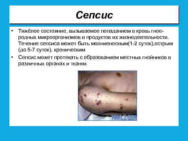 Сепсис • Тяжёлое состояние, вызываемое попаданием в кровь гноеродных микроорганизмов и продуктов их жизнедеятельности.