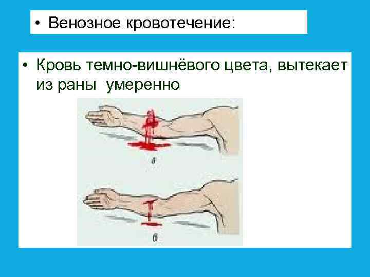  • Венозное кровотечение: • Кровь темно-вишнёвого цвета, вытекает из раны умеренно 