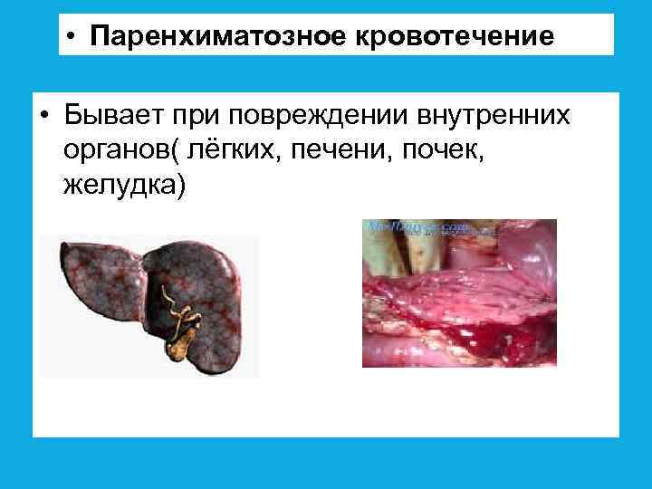  • Паренхиматозное кровотечение • Бывает при повреждении внутренних органов( лёгких, печени, почек, желудка)