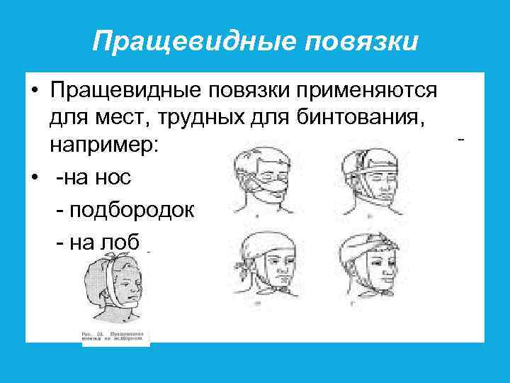 Пращевидные повязки • Пращевидные повязки применяются для мест, трудных для бинтования, например: • -на