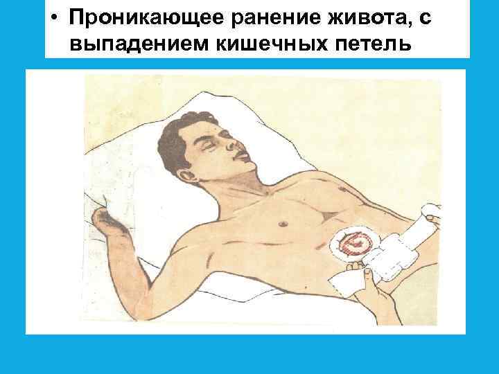  • Проникающее ранение живота, с выпадением кишечных петель 