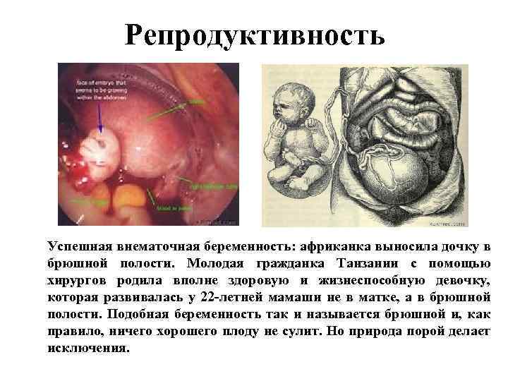 Репродуктивность Успешная внематочная беременность: африканка выносила дочку в брюшной полости. Молодая гражданка Танзании с