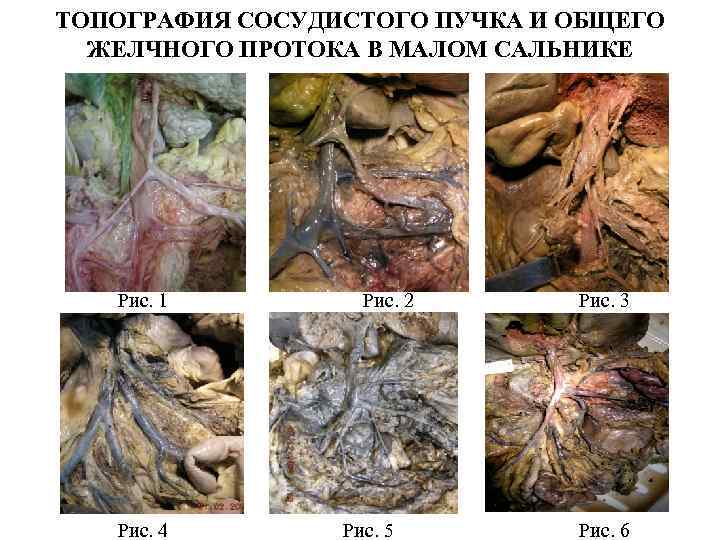 ТОПОГРАФИЯ СОСУДИСТОГО ПУЧКА И ОБЩЕГО ЖЕЛЧНОГО ПРОТОКА В МАЛОМ САЛЬНИКЕ Рис. 1 Рис. 2