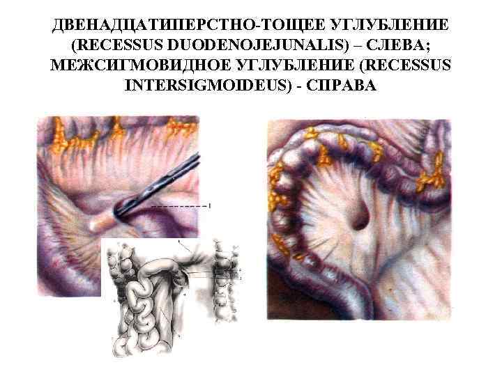 ДВЕНАДЦАТИПЕРСТНО-ТОЩЕЕ УГЛУБЛЕНИЕ (RECESSUS DUODENOJEJUNALIS) – СЛЕВА; МЕЖСИГМОВИДНОЕ УГЛУБЛЕНИЕ (RECESSUS INTERSIGMOIDEUS) - СПРАВА 