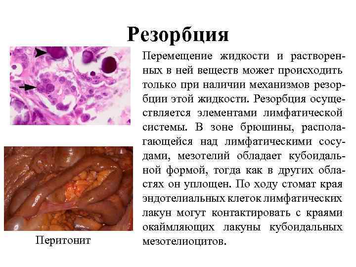 Резорбция Перитонит Перемещение жидкости и растворенных в ней веществ может происходить только при наличии