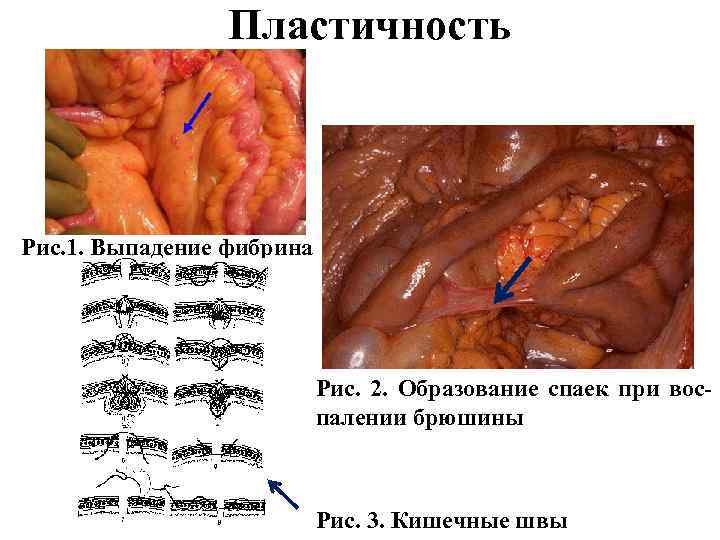 Пластичность Рис. 1. Выпадение фибрина Рис. 2. Образование спаек при воспалении брюшины Рис. 3.