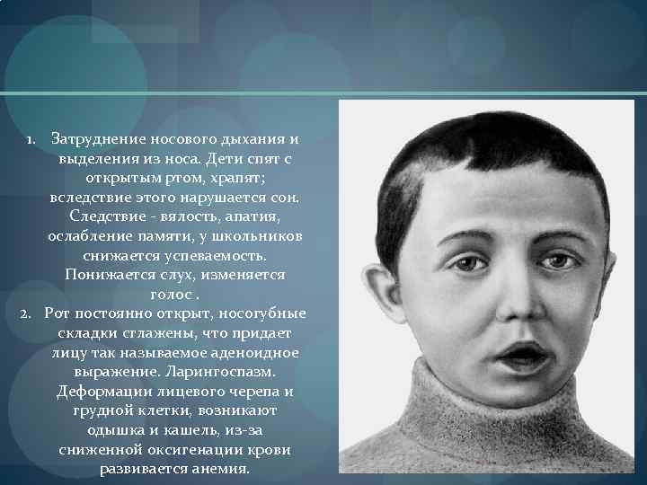 1. Затруднение носового дыхания и выделения из носа. Дети спят с открытым ртом, храпят;