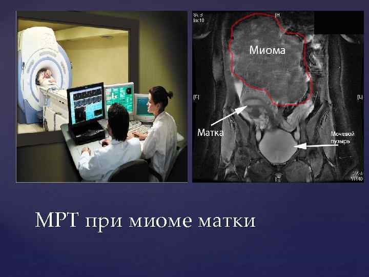 МРТ при миоме матки 