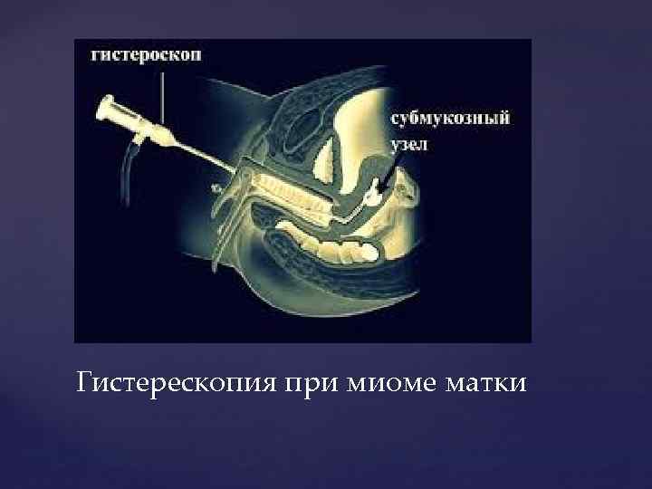 Гистерескопия при миоме матки 