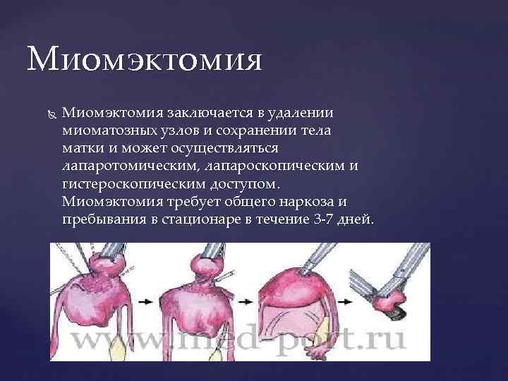 Миомэктомия заключается в удалении миоматозных узлов и сохранении тела матки и может осуществляться лапаротомическим,