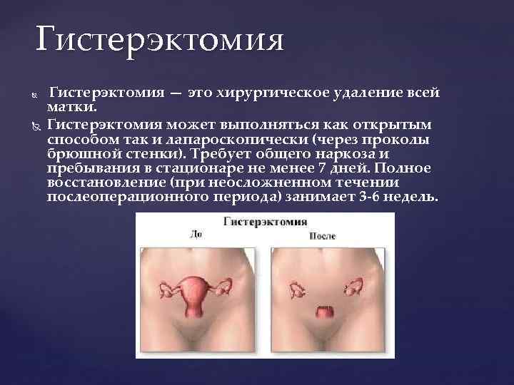 Гистерэктомия — это хирургическое удаление всей матки. Гистерэктомия может выполняться как открытым способом так