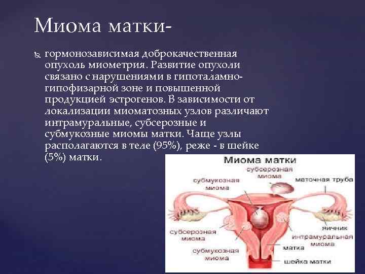 Миома матки гормонозависимая доброкачественная опухоль миометрия. Развитие опухоли связано с нарушениями в гипоталамногипофизарной зоне
