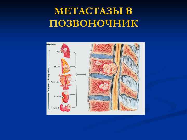 Метастазы в позвоночнике симптомы