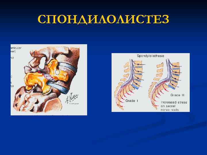 СПОНДИЛОЛИСТЕЗ 
