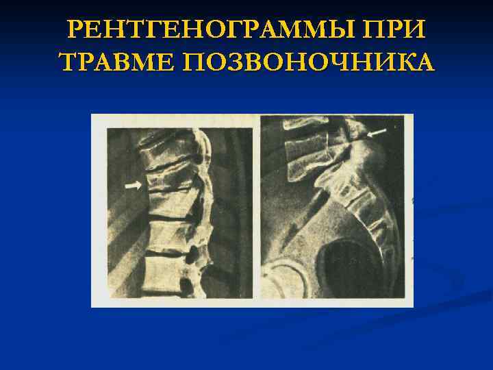 РЕНТГЕНОГРАММЫ ПРИ ТРАВМЕ ПОЗВОНОЧНИКА 