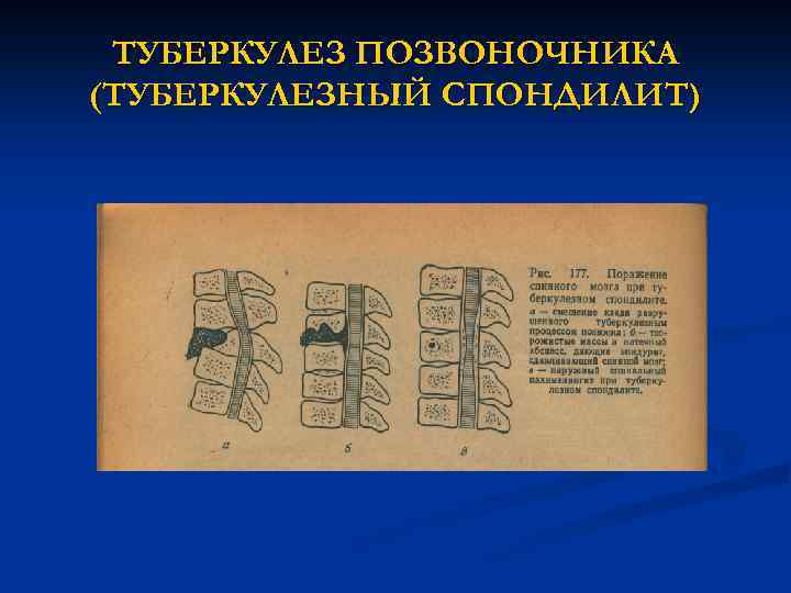 ТУБЕРКУЛЕЗ ПОЗВОНОЧНИКА (ТУБЕРКУЛЕЗНЫЙ СПОНДИЛИТ) 