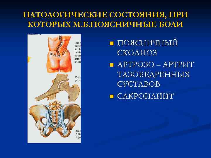 ПАТОЛОГИЧЕСКИЕ СОСТОЯНИЯ, ПРИ КОТОРЫХ М. Б. ПОЯСНИЧНЫЕ БОЛИ n n n ПОЯСНИЧНЫЙ СКОЛИОЗ АРТРОЗО