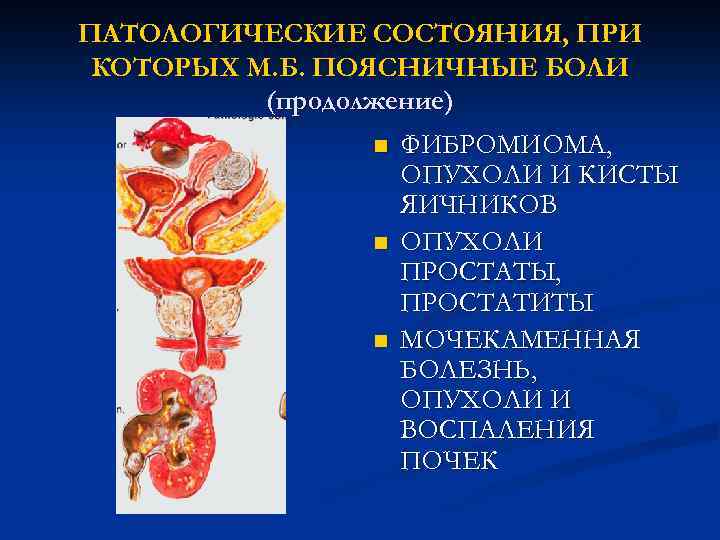 ПАТОЛОГИЧЕСКИЕ СОСТОЯНИЯ, ПРИ КОТОРЫХ М. Б. ПОЯСНИЧНЫЕ БОЛИ (продолжение) n n n ФИБРОМИОМА, ОПУХОЛИ