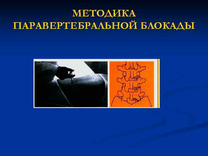 МЕТОДИКА ПАРАВЕРТЕБРАЛЬНОЙ БЛОКАДЫ 