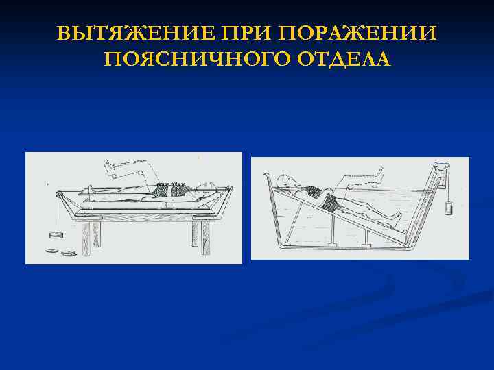 ВЫТЯЖЕНИЕ ПРИ ПОРАЖЕНИИ ПОЯСНИЧНОГО ОТДЕЛА 