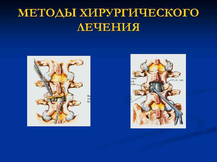 МЕТОДЫ ХИРУРГИЧЕСКОГО ЛЕЧЕНИЯ 
