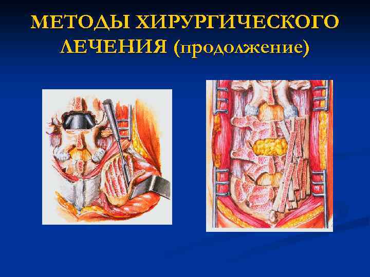 МЕТОДЫ ХИРУРГИЧЕСКОГО ЛЕЧЕНИЯ (продолжение) 
