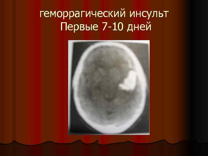 геморрагический инсульт Первые 7 -10 дней 
