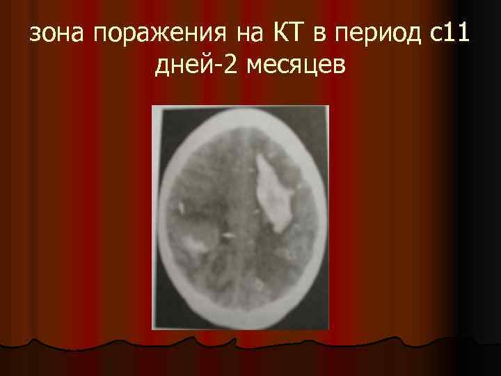 зона поражения на КТ в период с11 дней-2 месяцев 
