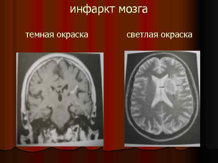 инфаркт мозга темная окраска светлая окраска 