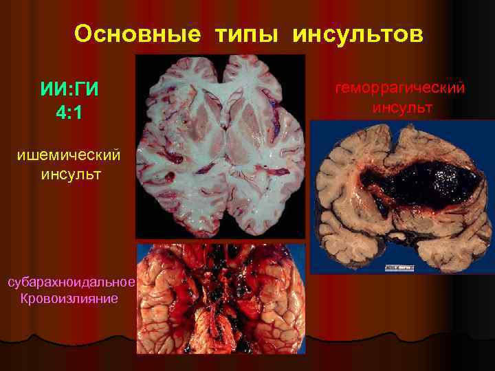 Основные типы инсультов ИИ: ГИ 4: 1 ишемический инсульт субарахноидальное Кровоизлияние геморрагический инсульт 