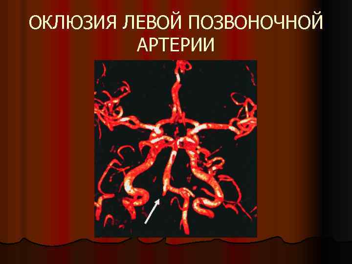 ОКЛЮЗИЯ ЛЕВОЙ ПОЗВОНОЧНОЙ АРТЕРИИ 