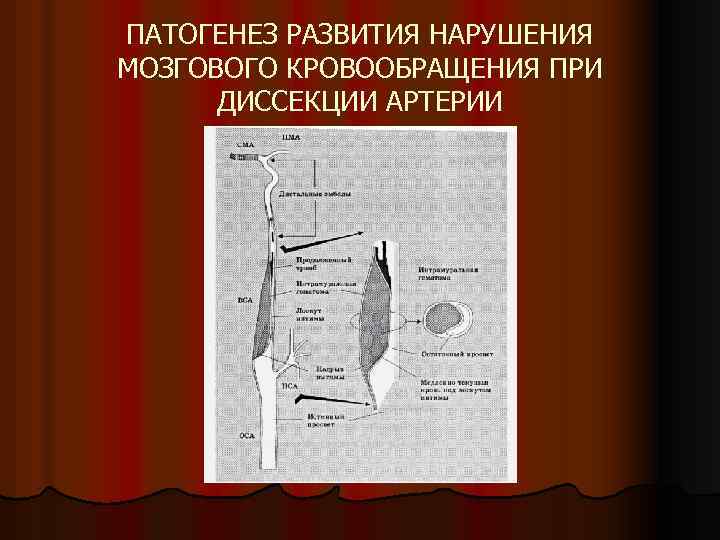 ПАТОГЕНЕЗ РАЗВИТИЯ НАРУШЕНИЯ МОЗГОВОГО КРОВООБРАЩЕНИЯ ПРИ ДИССЕКЦИИ АРТЕРИИ 