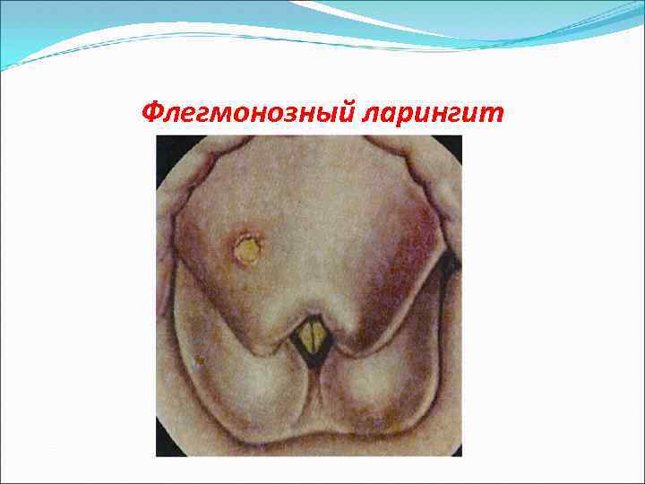 Флегмонозный ларингит 