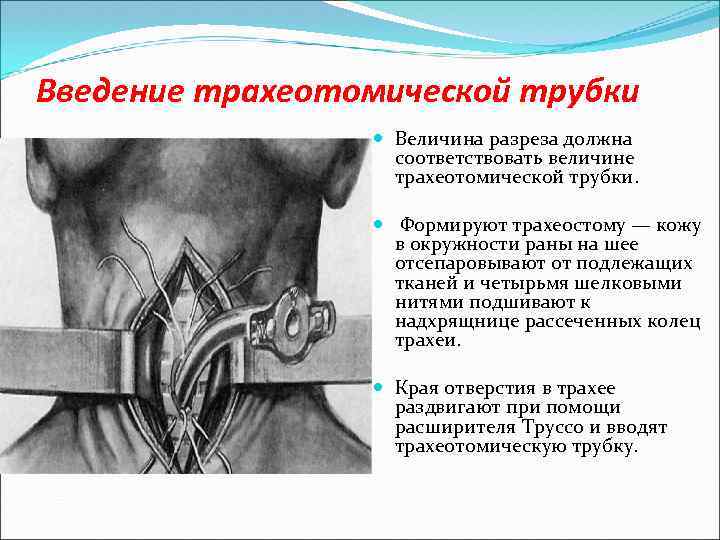 Несостоятельность трахеостомы карта вызова