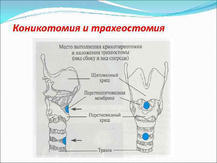 Место исполнения. Коникотомия методика выполнения. Коникотомия это микротрахеостомия это. Место выполнения коникотомии. Трахеостомия алгоритм выполнения.