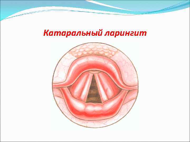 Катаральный ларингит 